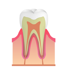 C0：初期の虫歯