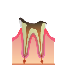 C4：末期の虫歯